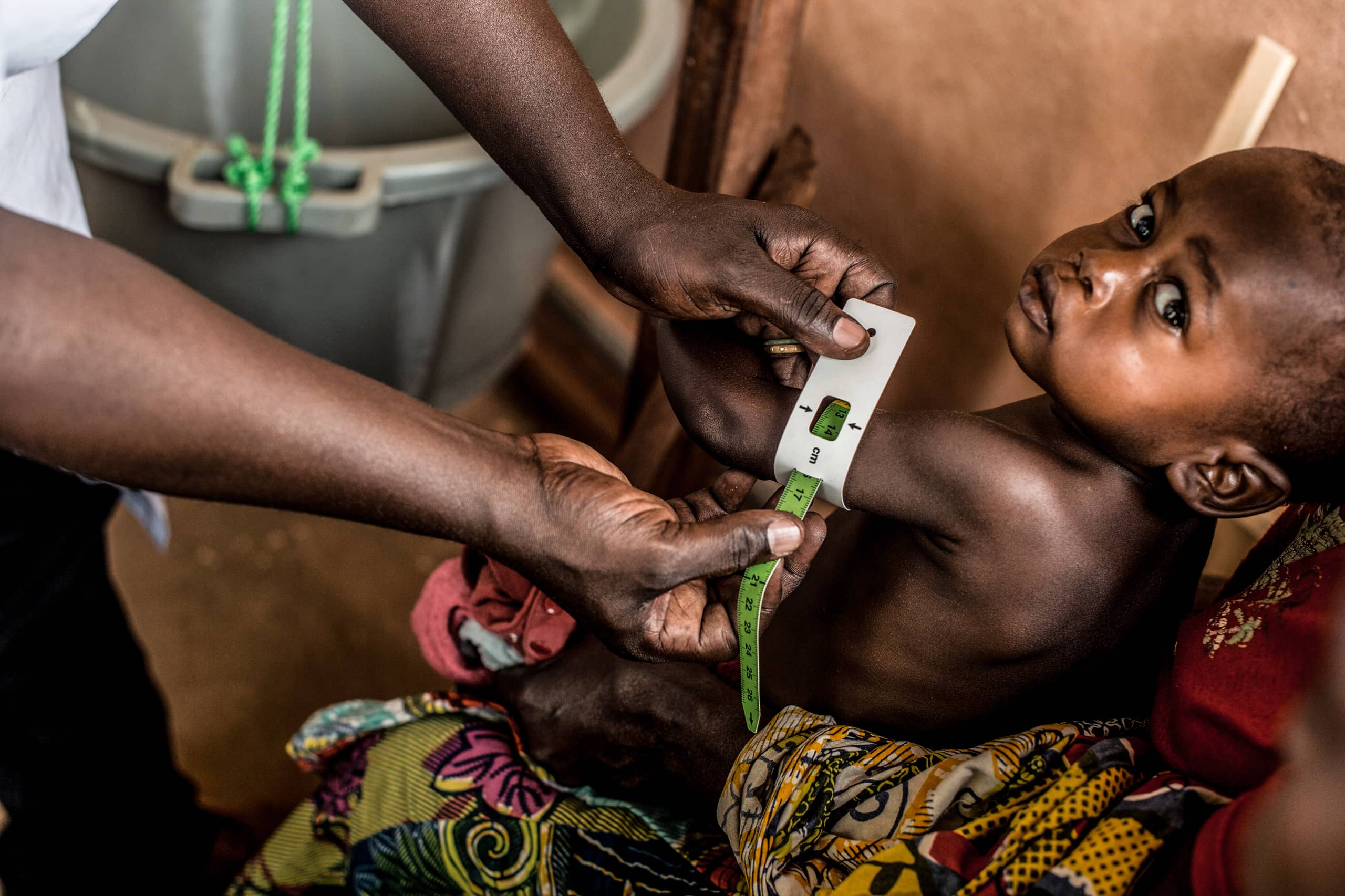 Unterernährtes Kind erhält medizinische Behandlung, zeigt den Hunger in Afrika.